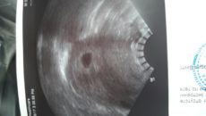 Кровотечение после эко на 6 неделе беременности