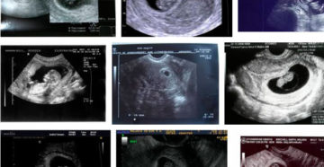 Восьмая неделя беременности акушерская форум