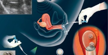 8 Неделя после переноса эмбрионов