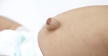 Пупочная грыжа у грудничка что делать Пупочная грыжа у грудничка что делать