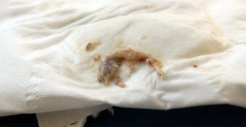 Коричневые выделения при беременности на 8 неделе