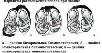 24 Неделя беременности двойня бихориальная