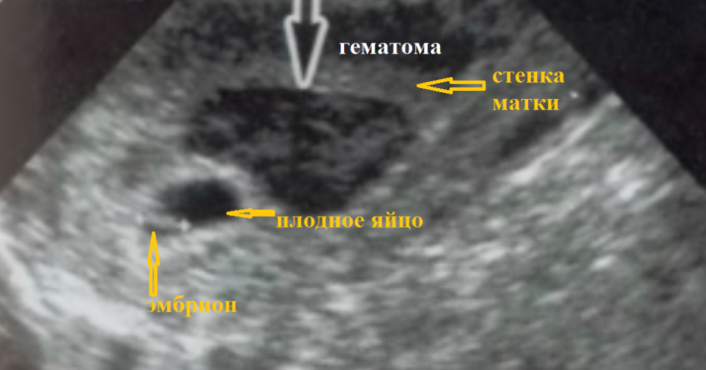 Гематома 11 неделе беременности
