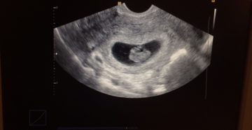 8 Недель узи 6