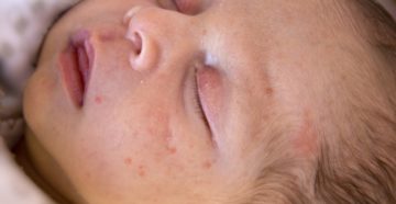 У новорожденного акне У новорожденного акне