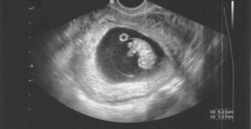 Анализы 9 неделе беременности