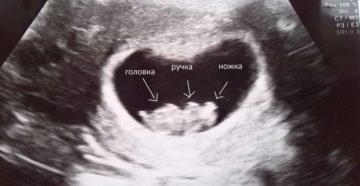 Почему замирает беременность на 8 неделе