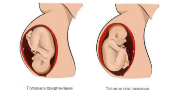 Головное предлежание плода 22 неделе