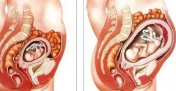 7 Неделя тянет внизу живота 7 Неделя тянет внизу живота