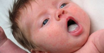 Молочница у ребенка на щеках Молочница у ребенка на щеках