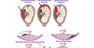 Отслойка плаценты 2 3 недели беременности