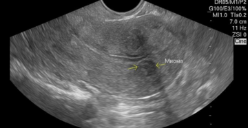 Миома матки 14 недель делать
