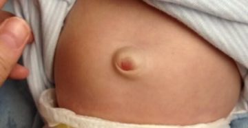 Пупок у новорожденного грыжа Пупок у новорожденного грыжа