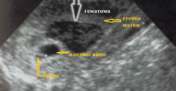 Беременность 7 недель гематома в матке Беременность 7 недель гематома в матке
